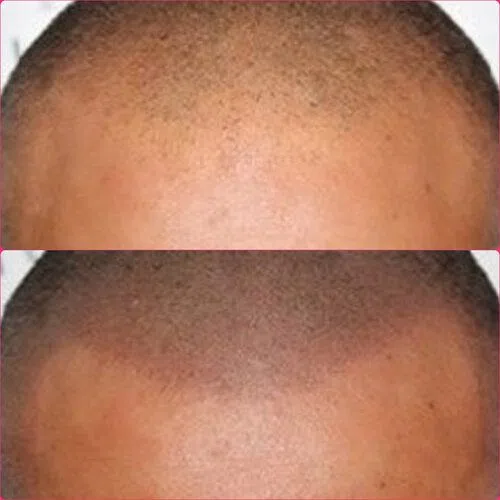 Scalp Micropigmentation result