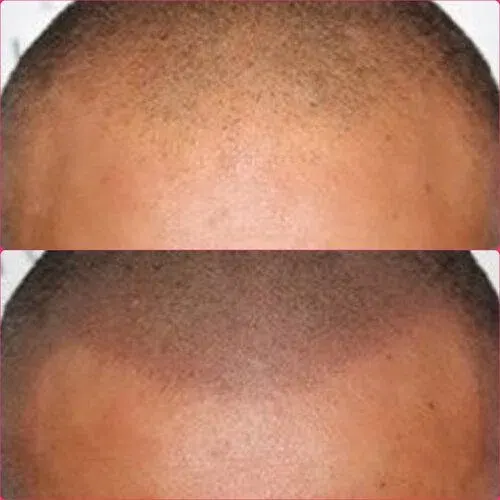 Scalp Micropigmentation result