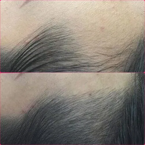 Scalp Micropigmentation result