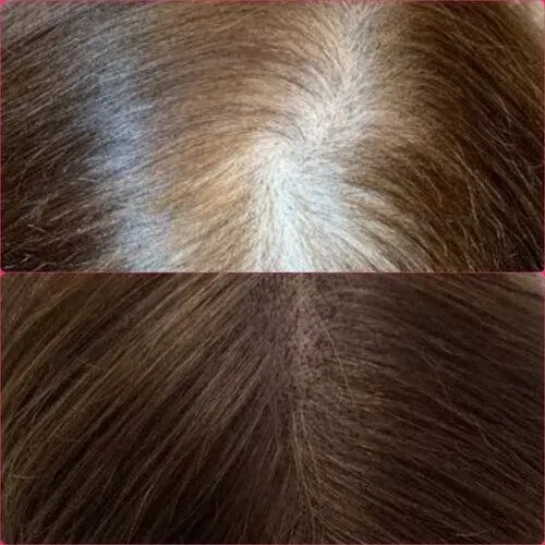 Scalp Micropigmentation result