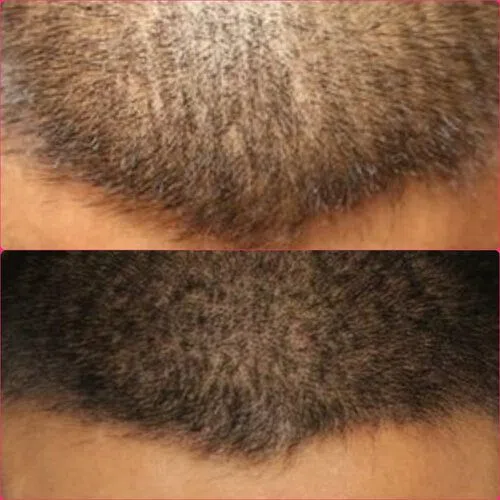 Scalp Micropigmentation result
