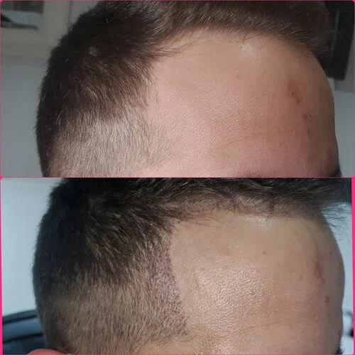 Scalp Micropigmentation result