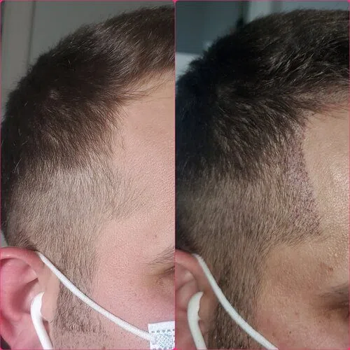 Scalp Micropigmentation result