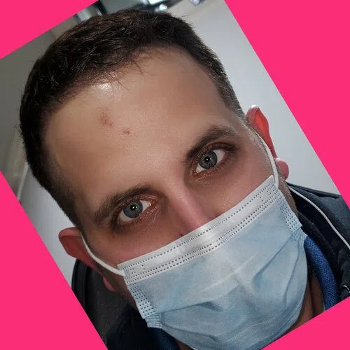 Scalp Micropigmentation result