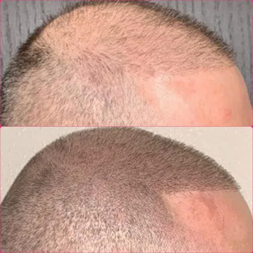 Scalp Micropigmentation result