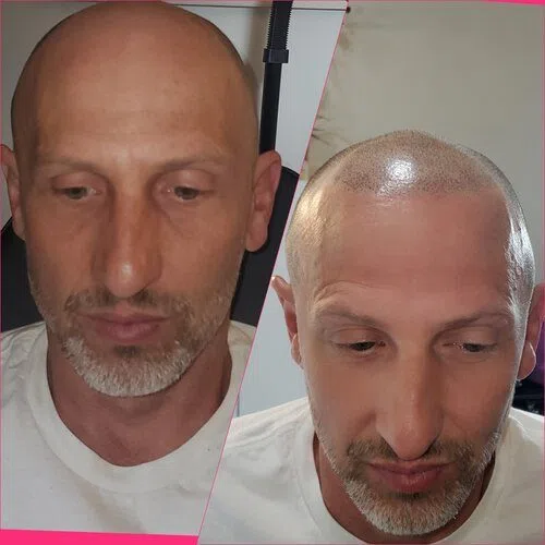 Scalp Micropigmentation result