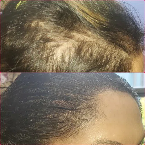 Scalp Micropigmentation result