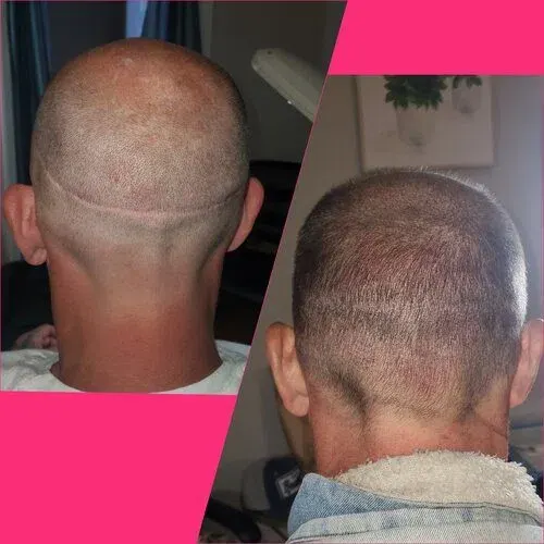 Scalp Micropigmentation result