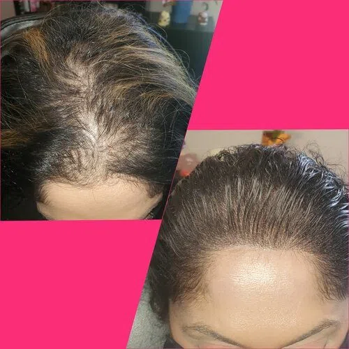 Scalp Micropigmentation result