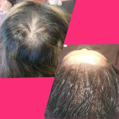 Scalp Micropigmentation result