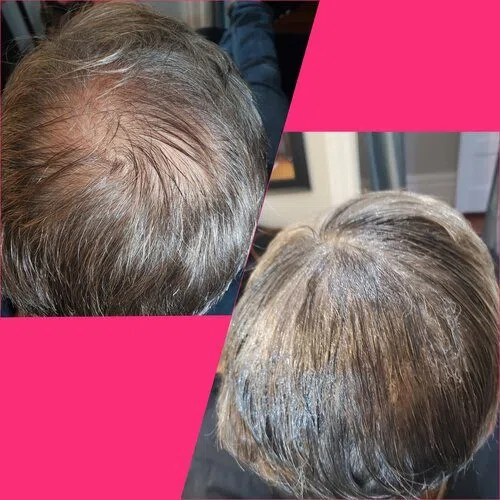 Scalp Micropigmentation result