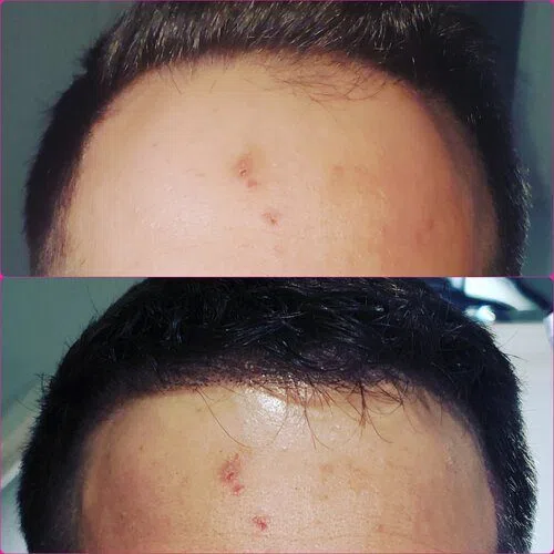 Scalp Micropigmentation result