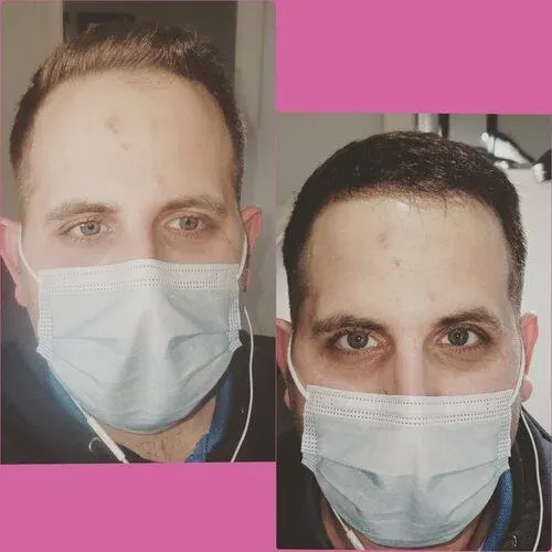 Scalp Micropigmentation result