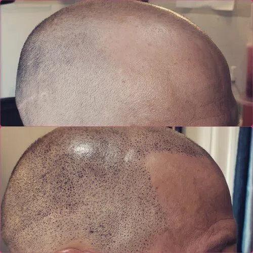 Scalp Micropigmentation result