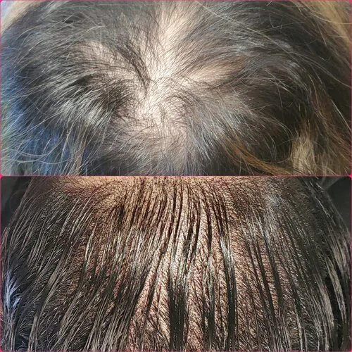 Scalp Micropigmentation result