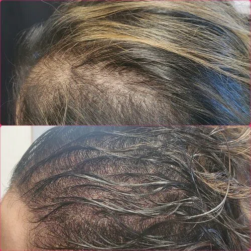 Scalp Micropigmentation result