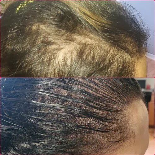 Scalp Micropigmentation result