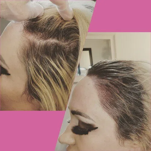 Scalp Micropigmentation result