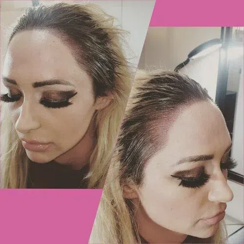 Scalp Micropigmentation result