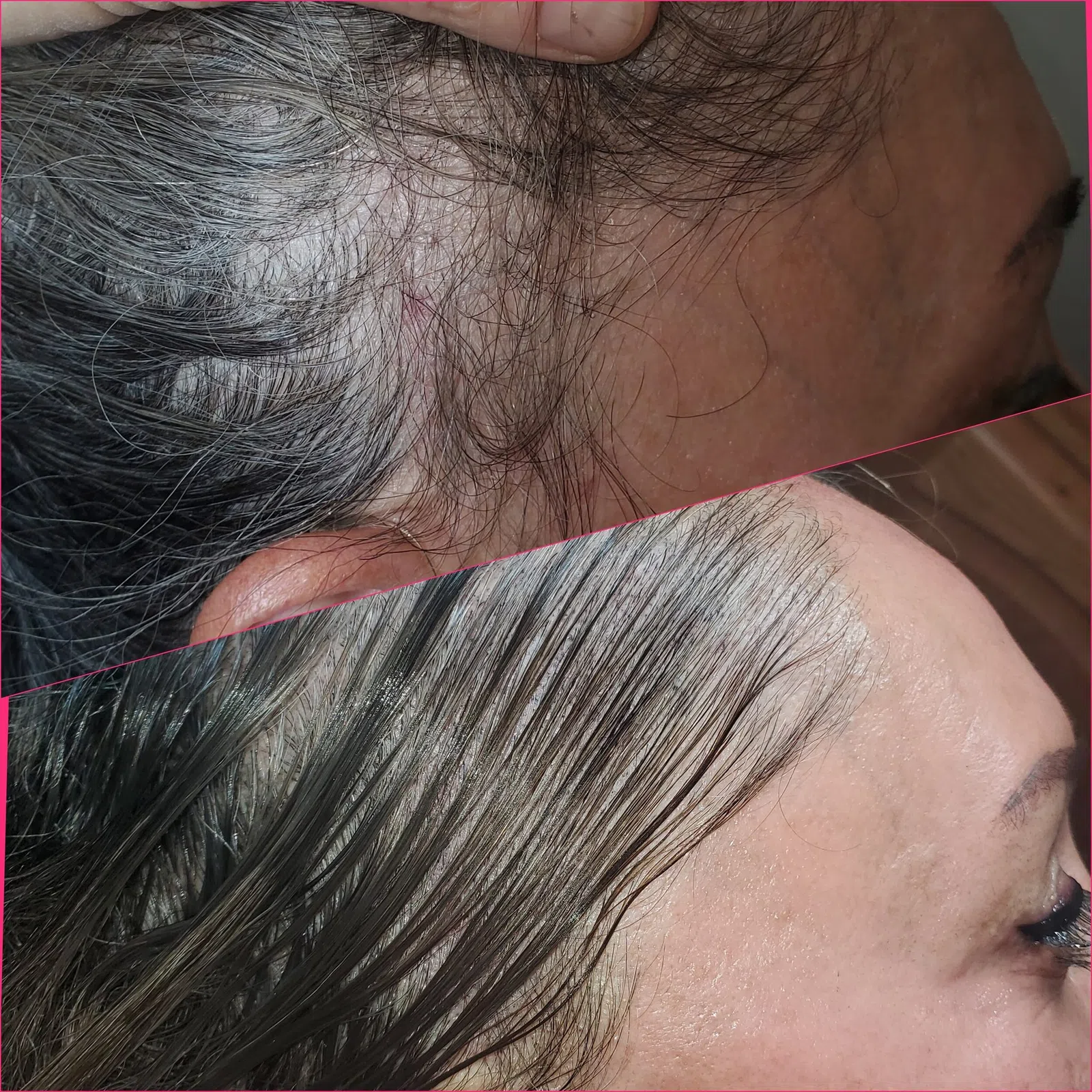 Scalp Micropigmentation result