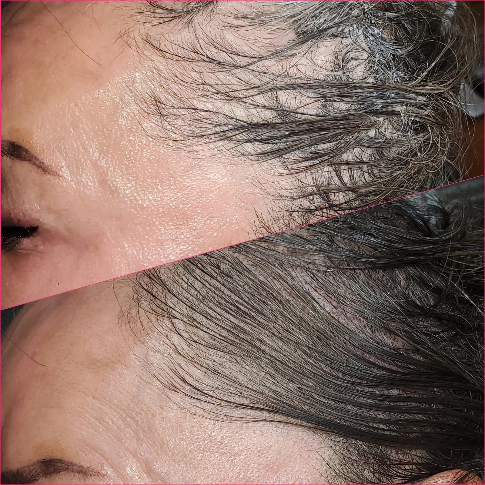 Scalp Micropigmentation result