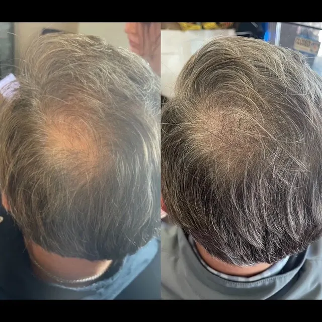Scalp Micropigmentation result