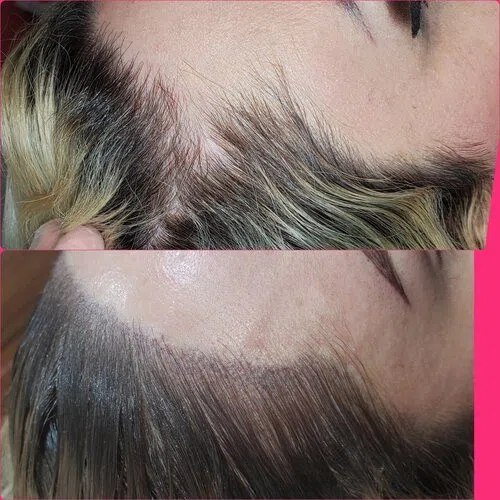 Scalp Micropigmentation result