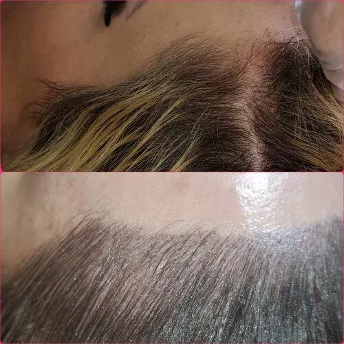 Scalp Micropigmentation result