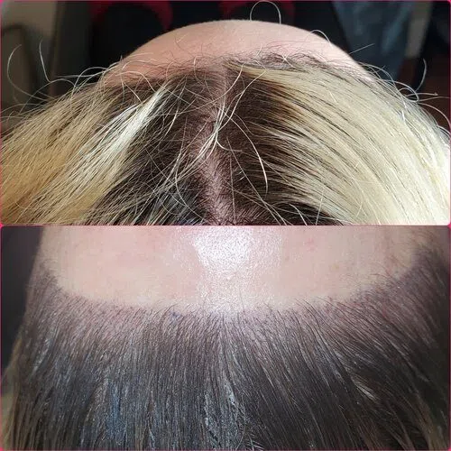 Scalp Micropigmentation result