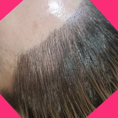 Scalp Micropigmentation result