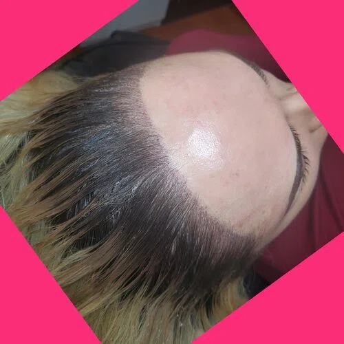 Scalp Micropigmentation result