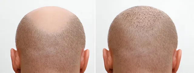 Scalp Micropigmentation: A New Approach to Hair Restoration