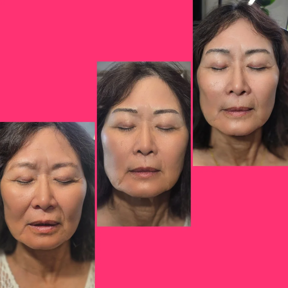 Nano Machine Hair Strokes fresh and healed result example 1